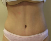 Feel Beautiful - Tummy Tuck Case 9 - After Photo